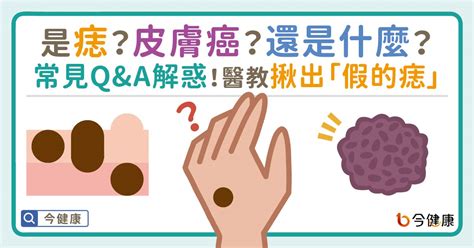 臉上的痣|是痣？皮膚癌？還是什麼？常見Q&A解惑！醫教揪出「。